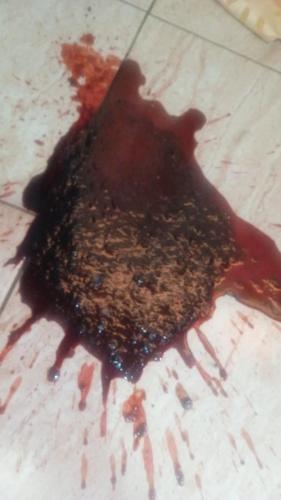 Vomito de sangre